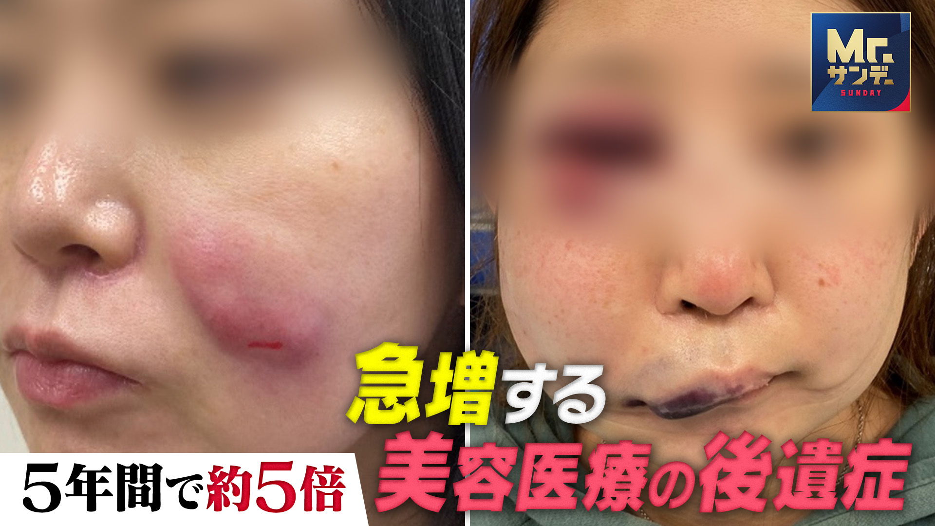 美容医療ブームの裏で急増する後遺症の実態